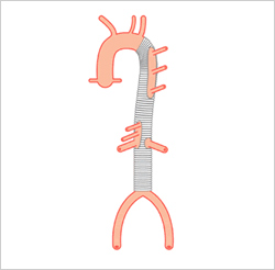 胸腹部大動脈瘤の治療