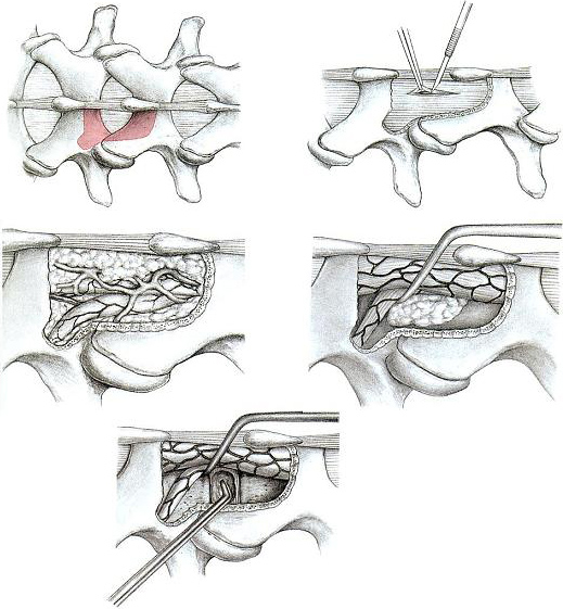 腰椎椎間板ヘルニア摘出術