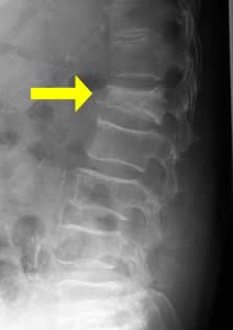 脊椎圧迫骨折（矢印部分）