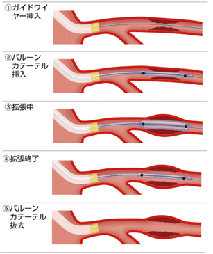 バルーン拡張術