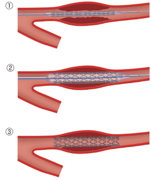ステント治療