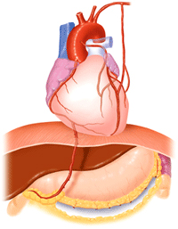 冠動脈バイパス手術