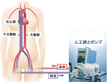 ECMO