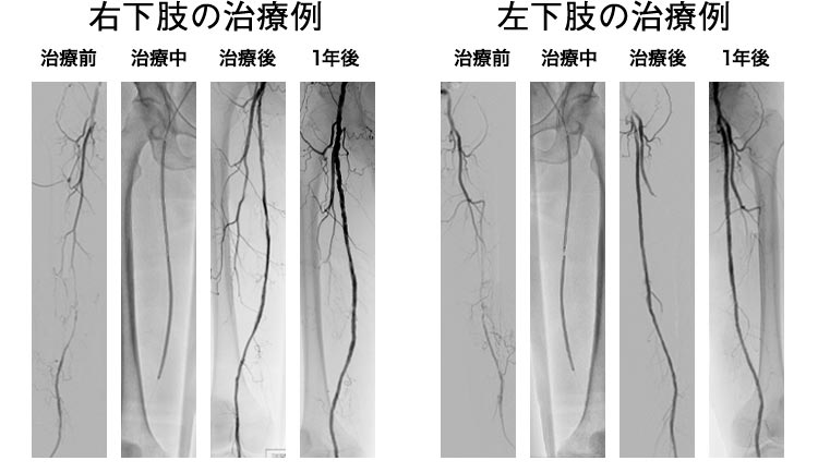 カテーテル治療