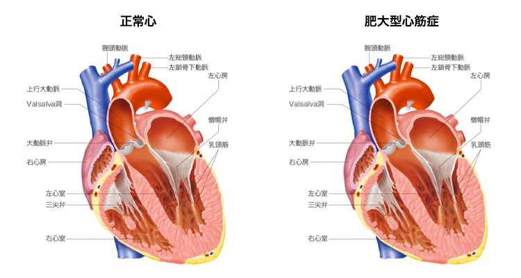 （閉塞性）肥大型心筋症