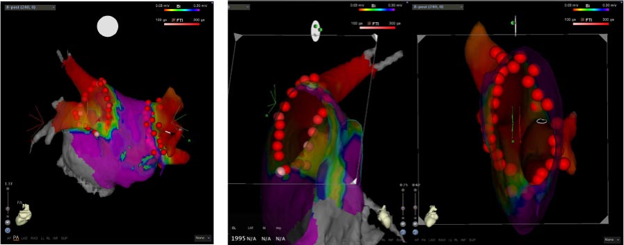 図3 CARTOシステムを用いた心房細動治療の例