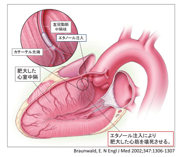 PTSMA