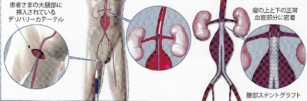 ステントグラフトによる胸部・腹部大動脈瘤治療イメージ