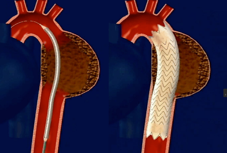 ステントグラフトによる胸部・腹部大動脈瘤治療イメージ
