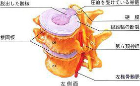 頸椎椎間板ヘルニアのシェーマ