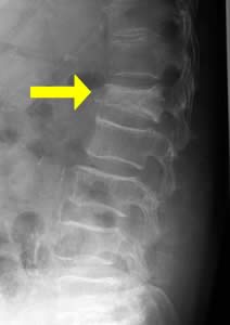 脊椎圧迫骨折（矢印部分）