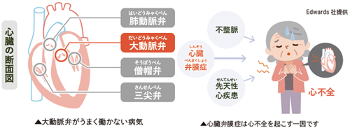 大動脈弁狭窄症