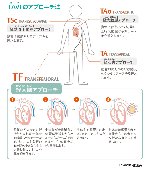 taviアプローチ