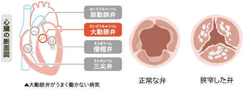 大動脈弁狭窄症